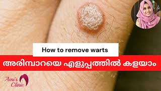 അരിമ്പാറ എങ്ങനെ കളയാം how to remove warts malayalam arimpara [upl. by Tabby107]