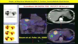 Neuroendocrine Tumors Diagnosis amp Treatment w Peptide Receptor RadiotherapyPRRT Dr Baum 2of2 [upl. by Orthman]