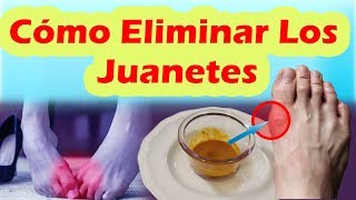 Como Eliminar Los Juanetes De Forma Natural COMO CORREGIR LOS JUANETES SIN CIRUGÍA [upl. by Annodal635]