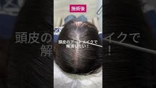 女性の薄毛は改善がとても難しい。アートメイク 頭皮アートメイク 薄毛 生え際 ヘアアートメイク m字はげ 薄毛治療 薄毛改善 頭皮タトゥー ヘアタトゥー ヘアラインアートメイク [upl. by Keary732]