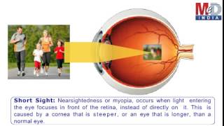 How To Correct ShortSightedness [upl. by Ilene]