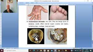 Head and neck surgery in Arabic 7  Cystic Hygroma and types of dermoid cysts   by Dr Wahdan [upl. by Etnahs]