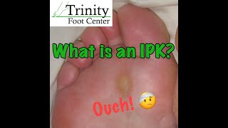 What is an Intactable Plantar Keratosis or IPK [upl. by Amehr45]