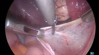 Lap excision of incidentally found deep endometriosis in a patient with mucinous ovarian cyst [upl. by Einahpets]