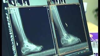 A Better Look at Ankle Surgery [upl. by Chadburn]