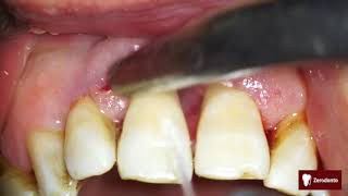 Advanced periodontal disease [upl. by Ntsyrk507]