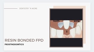 RESIN BONDED FPD [upl. by Stu378]