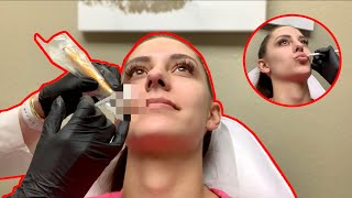 BOTOX LIP FLIP  WHY I COULDNT GET FILLERS [upl. by Aliak]