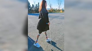 Amputee Girl Walking Smart with a Stick  DAK Amputee  Double Prosthesis [upl. by Ssor712]