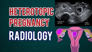 Heterotopic Pregnancy  Ectopic amp Normal Pregnancy  Radiology [upl. by Kayne]