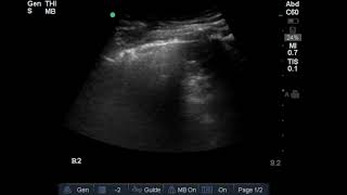 Pneumonia lung [upl. by Halbeib]