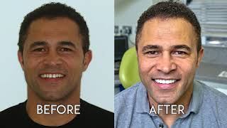 SmileFast Veneers at Farsley Dental Practice [upl. by Strenta]