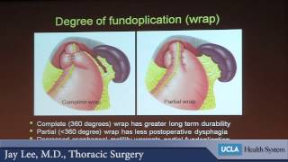 Surgery and the Esophagus  What does minimally invasive mean  Dr Jay Moon Le [upl. by Brouwer]