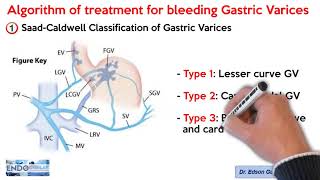 ALGORITHM OF THE TREATMENT FOR BLEEDING GASTRIC VARICES [upl. by Yznel]