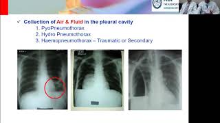 Safe Insertion Maintenance amp Removal of Chest Tube  Dr Arvind Kumar [upl. by Lezah]