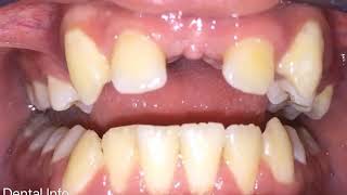 DrAmmar Kasem Impacted Central Incisors  Full Video [upl. by Venn81]