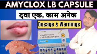 Amyclox LB Capsule Review  Amoxycillin  Cloxacillin amp Lactic Acid Bacillus Capsules Uses In Hindi [upl. by Akemej414]