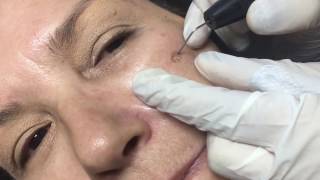 Lentigo treatment by Plasmage ® Brera Medical [upl. by Sapphera48]