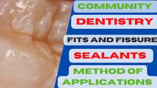 Method of Sealent ApplicationPits and fissure sealants procedurePits and fissure sealants in Hindi [upl. by Akfir]