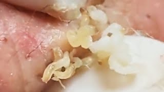 Blackheads Removal Whiteheads Cystic Acne Treatment Pimple Popping Remove Milia on Skin [upl. by Vivia]