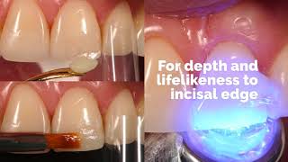 Chip Repair with Composite Resin by Dr Newton Fahl [upl. by Aihtenak]