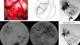 Surgical Treatment of Juvenile Patients with Moyamoya DiseaseHemodynamic Measurement [upl. by Rellim]