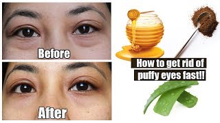 How to reduce puffy eyes in 15 minutes  Home remedies [upl. by Zinnes]