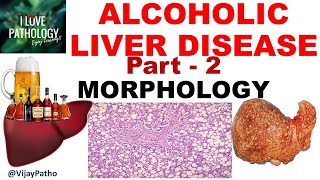 ALCOHOLIC LIVER DISEASE Part 2 Morphology Clinical Features amp Complications including cirrhosis [upl. by Sawyere]