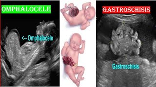 Omphalocele VS Gastroschisis on Ultrasound [upl. by Kitarp]