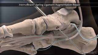 InternalBrace™ Spring Ligament Augmentation Repair [upl. by Carmen]