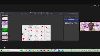 CITOMETRÍA DE FLUJO EN NEOPLASIAS MIELOIDES Y LINFOIDES ALGUNAS [upl. by Aliab116]