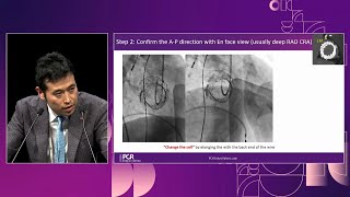 Learn the evidence  Lifetime management of aortic stenosis therapy with selfexpandable valve [upl. by Emirak]