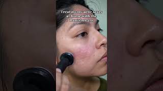 Acne scars stand no chance when using this microneedling tool acne acnescars skincare [upl. by Florie]