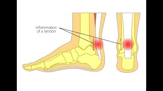 Achilles Tendinitis Symptoms and Causes  Diagnosis  Treatment  Prevention [upl. by Eeima174]