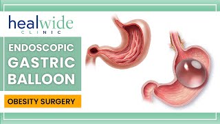 Gastric balloon  Endoscopic Gastric Balloon  nonsurgical weightloss procedure  in TURKEY [upl. by Verity720]