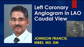 Left Coronary Angiogram In LAO Caudal View [upl. by Arri]