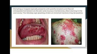 Autoimmune diseases pemphigus vulgaris vs bullous pemphigoid [upl. by Essenaj366]