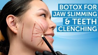 Botox for Jaw Slimming and Teeth Clenching  AAFE [upl. by Ylagam746]