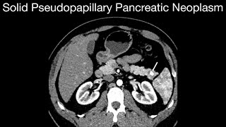 Solid Pseudopapillary Pancreatic Neoplasm [upl. by Eiznikcm]