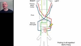 Hemiplegia 4 [upl. by Ivor]