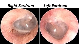 The Normal Eardrum  Otoendoscopy view [upl. by Oberon509]