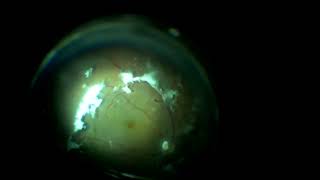 Vitrectomy  PPV surgery in VFT associated Macular hole  Rajeev Gupta Sangam Netralaya Mohali [upl. by Ranique]