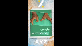 دیاردەی ectrodactyly [upl. by Hares]