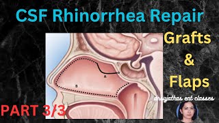 236Endoscopic Repair CSF Rhinorrhea Grafts and Flaps Part 33 surgeryeducation dentallectures [upl. by Ebeneser]