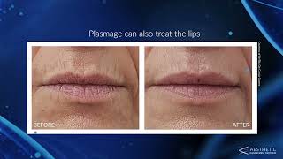 What Is Plasmage®  Introducing Fractional Plasma Technology To Treat Wrinkles amp Other Skin Concerns [upl. by Eeramit]