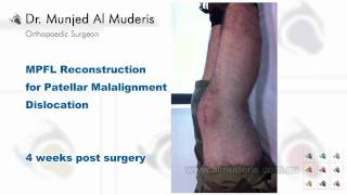 MPFL Reconstruction for Patellar Malalignment Dislocation  4 weeks post surgery [upl. by Lehar]