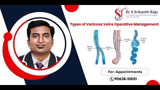 Varicose Veins Operative Management Types  DrSrikanth Raju  Vascular Surgeon  Hyderabad [upl. by Brookes665]