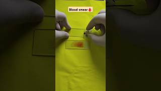 blood smear preparation  blood smear preparation and staining  blood smear technique dmlt bmlt [upl. by Otnas]