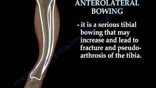 Tibial Bowing  Everything You Need To Know  Dr Nabil Ebraheim [upl. by Annaik827]