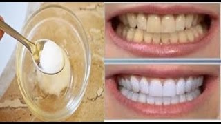 Como Clarear Os Dentes Em 1 Minuto Gastando Pouco Com 3 Receitas Caseiras [upl. by Tommi]